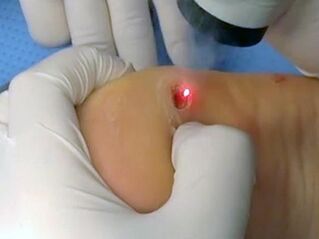 laser wart treatment