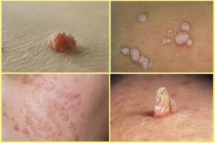 types of warts
