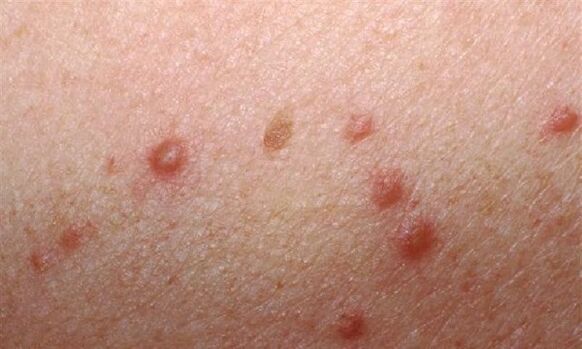 Appearance of papillomas on a woman's skin