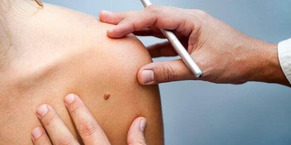 Examination of the patient by a dermatologist before removal of the papilloma