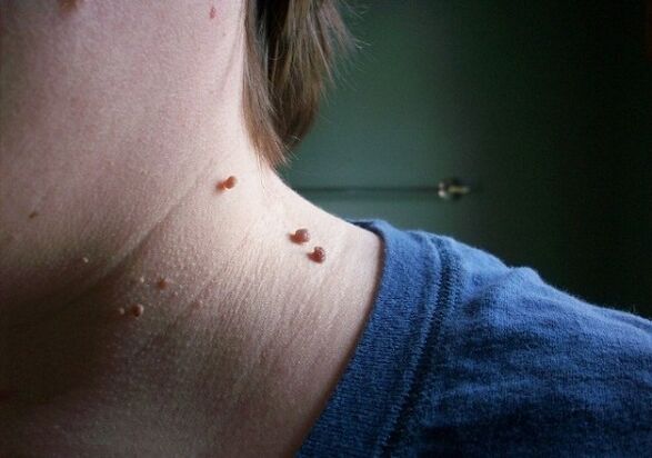 papillomas on the neck