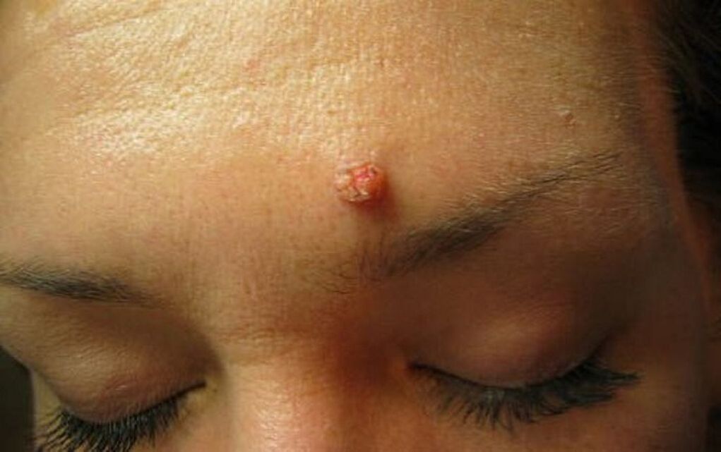 wart on the forehead