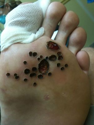 After removing the wart on the foot with a laser