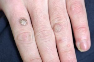 Warts on his hands